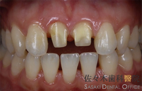 前歯をオールセラミックスで施術した治療例　※画像をクリニックすると拡大します。