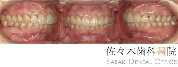 セラミック治療で歯ぐきの形も整えた治療例　※画像をクリニックすると拡大します。