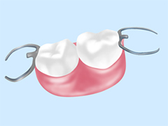 もっとも一般的な補綴治療「入れ歯治療」