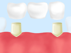 外科処置をおこなわない体に優しい「ブリッジ治療」