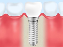 本物の歯と変わりない見た目や咬み心地を実現できる「インプラント」
