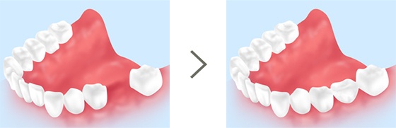 歯を失った部分に自分の歯を移植する治療「歯牙移植」